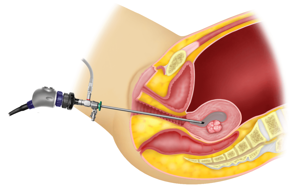 Hysteroscope within the uterus